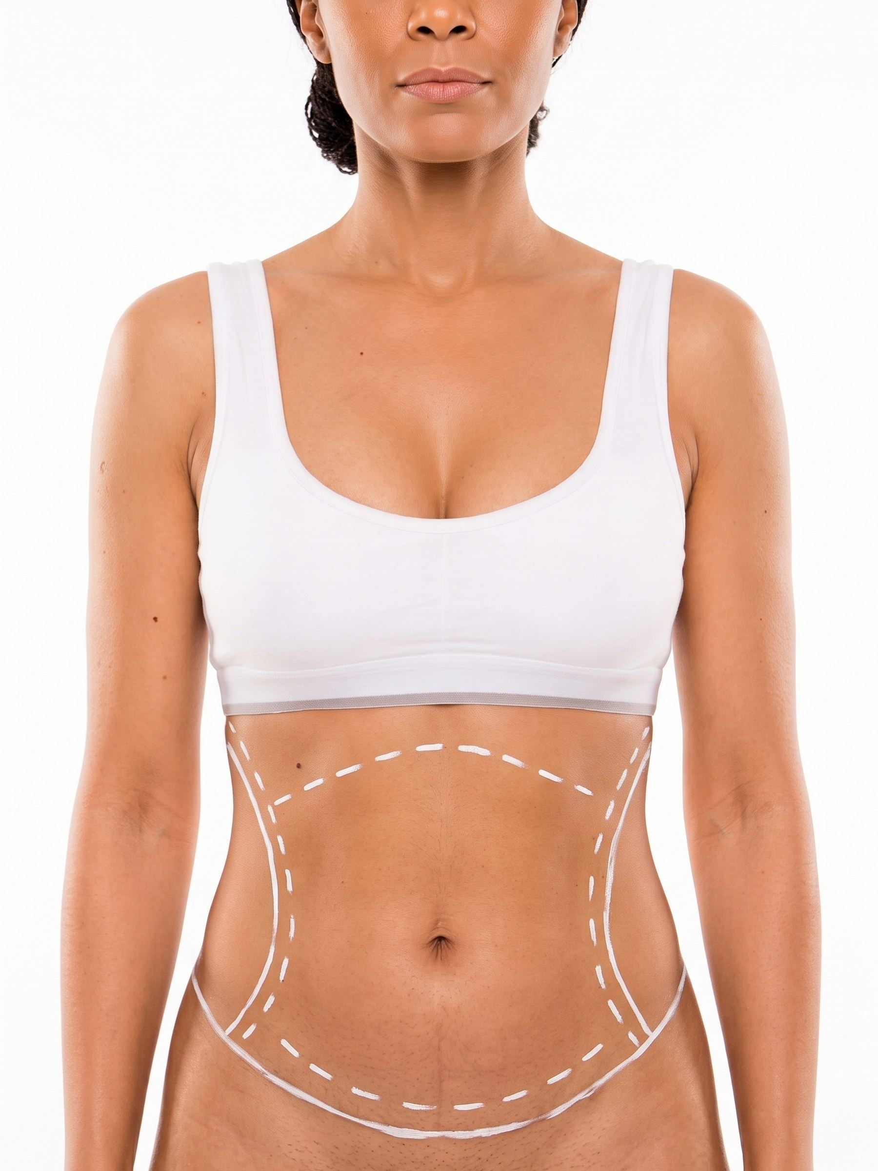 Lipoabdominoplastia