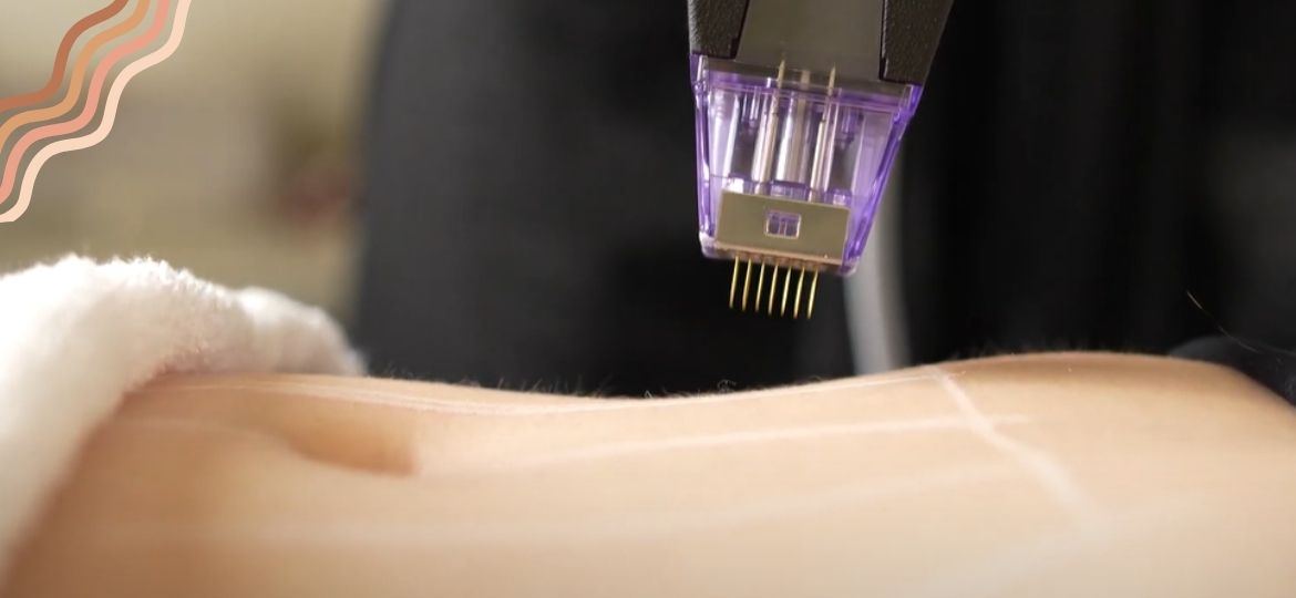 Morpheus8